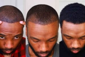 Hair Transplant Turkey