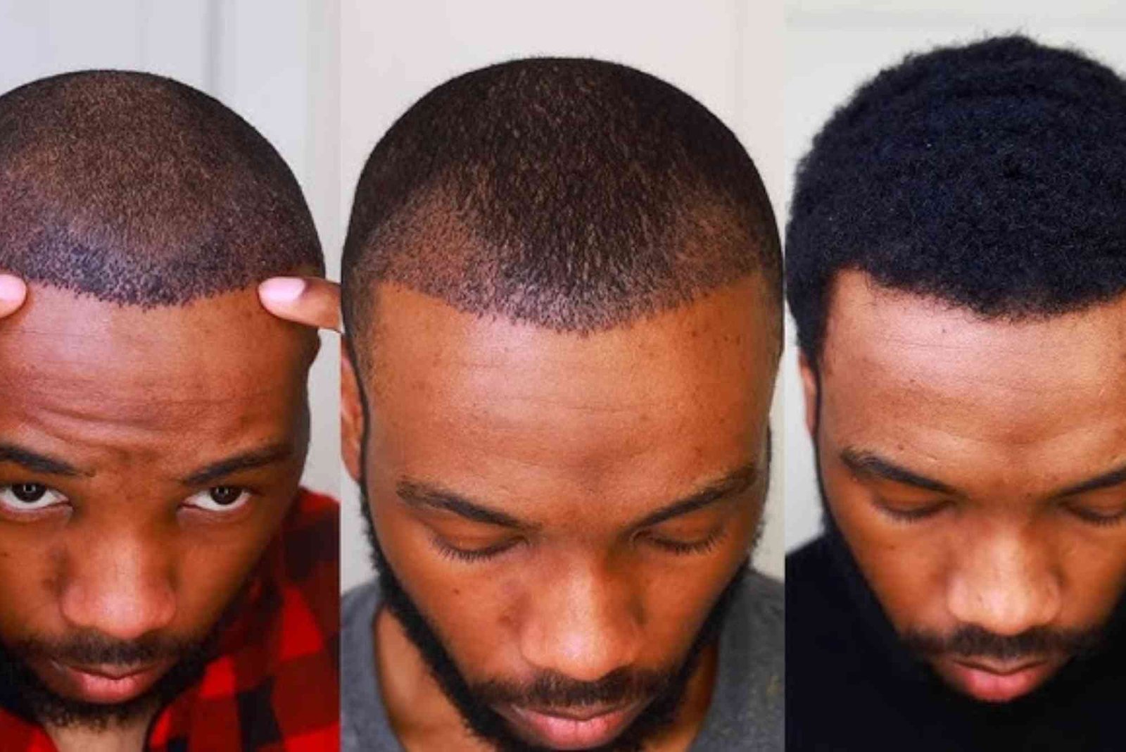 Hair Transplant Turkey